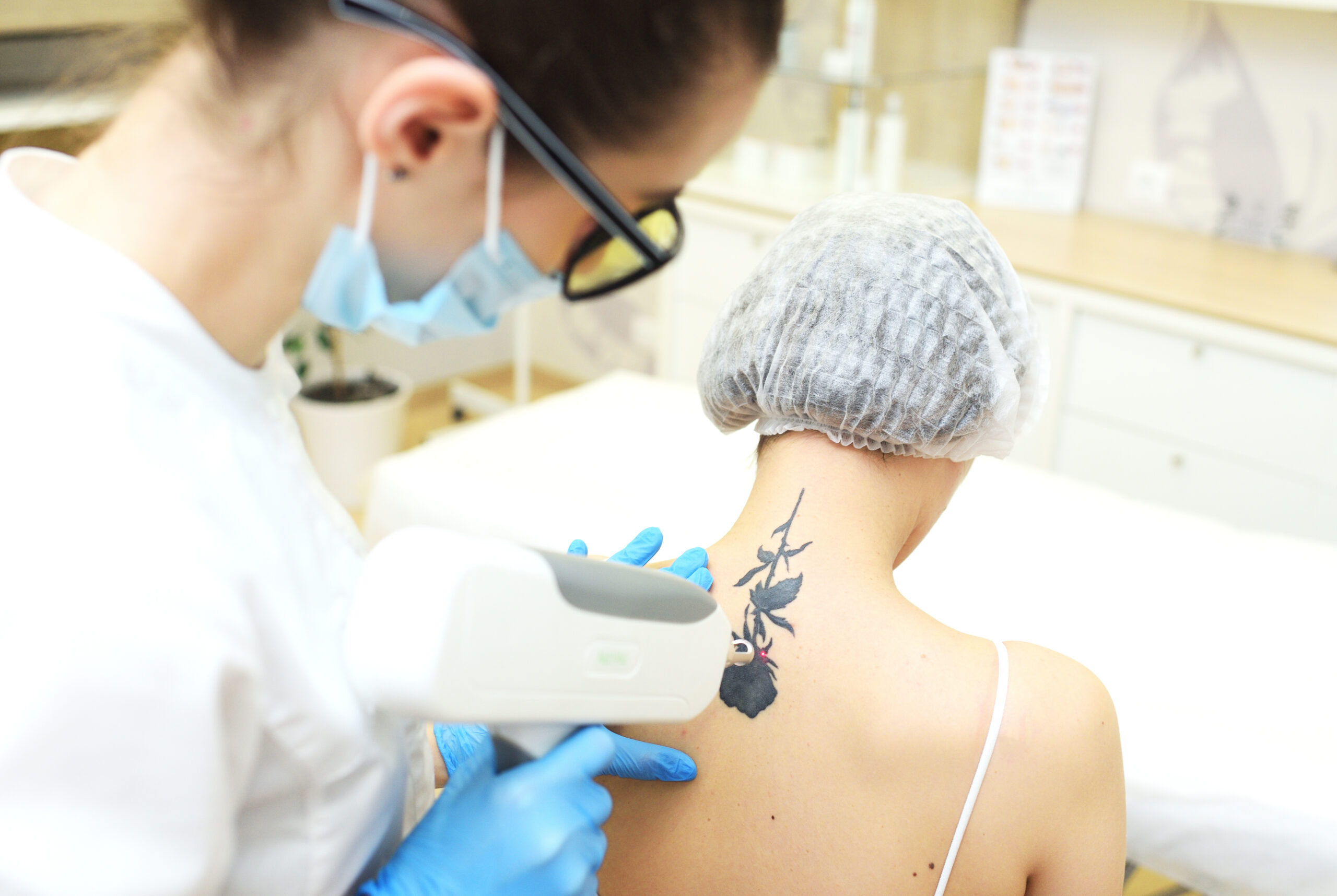 La Máquina Láser ND-YAG Q-SWITCHED se utiliza para eliminar tatuajes de forma eficaz y segura